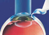 lasik-e1667345160116